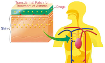 Asthma Patch: The Newest Treatment for Bronchial Asthma-By Edter